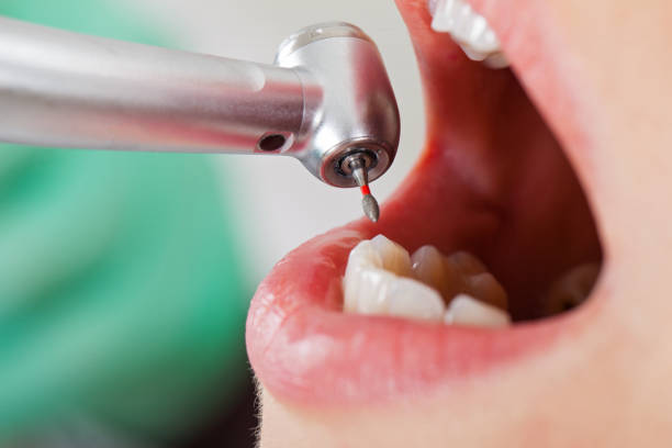 Best Emergency Dentist for Lost Fillings or Crowns in Burgaw, NC